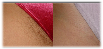 Bikini area before and after hair removal