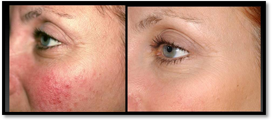 Couperose laser: before / after picture