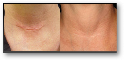 Avant / après Photo de la cicatrice d'une trachéotomie, la cicatrice est à peine visible après