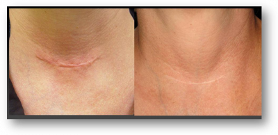 Avant / après photo de la cicatrice d'une trachéotomie, la cicatrice est à peine visible après Avant / après Photo de la cicatrice d'une trachéotomie, la cicatrice est à peine visible après