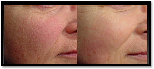Rosacea laser treatment: before / after image