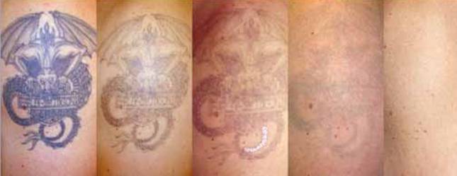 Tattoo removal before and after in 4 treatments