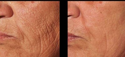 Wrinkle treatment before vs. after