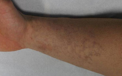 Tattoo removal Bern: Arm tattoo after 4 treatments