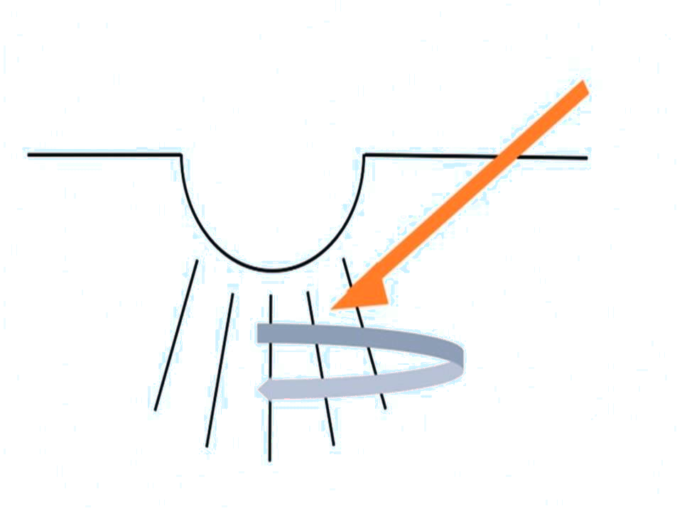 Aknebehandlung Bern: Schema Laser-Aknenarben-Bern-hautarzt-bubenberg.ch_.png
