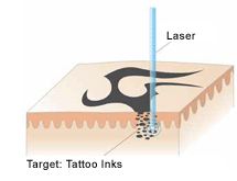 Funktionsweise des Lasers | hautarzt-bubenberg.ch Schematische Darstellung der Funktionsweise des Lasers | hautarzt-bubenberg.ch