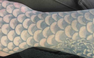 Tattooentfernung Bern: Tattoo vor der Entfernung | hautarzt-bubenberg.ch Tattooentfernung Bern: Fisch-Schuppen-Tattoo vor der Entfernung | hautarzt-bubenberg.ch