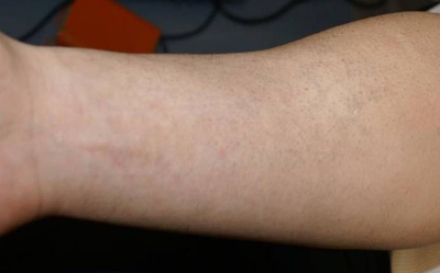 Tattooentfernung Bern: Arm-Tattoo nach 6 Behandlungen | hautarzt-bubenberg.ch Tattooentfernung Bern: Fisch-Schuppen-Arm-Tattoo komplett entfernt nach 6 Behandlungen | hautarzt-bubenberg.ch