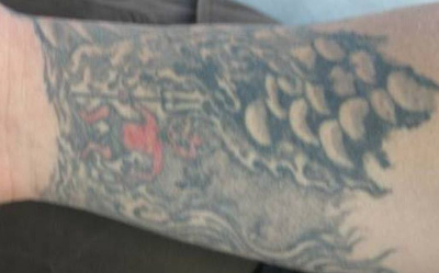 Tattooentfernung Bern: Arm-Tattoo vor Entfernung | hautarzt-bubenberg.ch Tattooentfernung Bern: Fisch-Schuppen-Arm-Tattoo vor Entfernung | hautarzt-bubenberg.ch