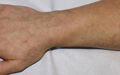Tattooentfernung Ergebnisse: Tattoo nach 4 Behandlungen | hautarzt-bubenberg.ch Tattooentfernung Ergebnisse: Fisch-Schuppen-Tattoo kaum mehr sichtbar nach 4 Behandlungen | hautarzt-bubenberg.ch