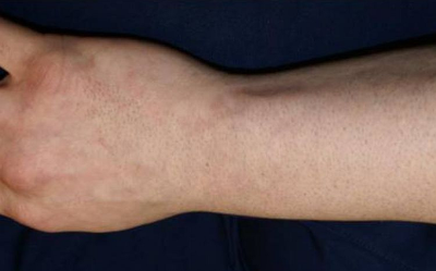 Tattooentfernung Ergebnisse: Tattoo nach 6 Behandlungen | hautarzt-bubenberg.ch Tattooentfernung Ergebnisse: Fisch-Schuppen-Tattoo komplett entfernt nach 6 Behandlungen | hautarzt-bubenberg.ch