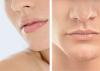 Lip injections
